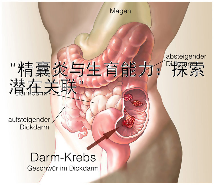 精囊炎与生育能力：探索潜在关联