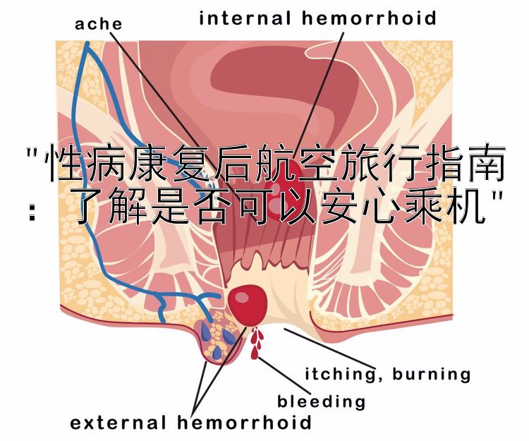 性病康复后航空旅行指南：了解是否可以安心乘机