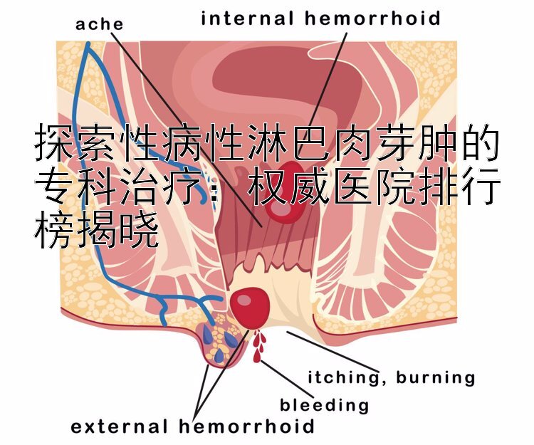 探索性病性淋巴肉芽肿的专科治疗：权威医院排行榜揭晓