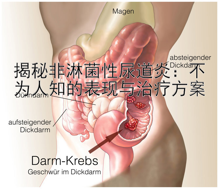 揭秘非淋菌性尿道炎：不为人知的表现与治疗方案