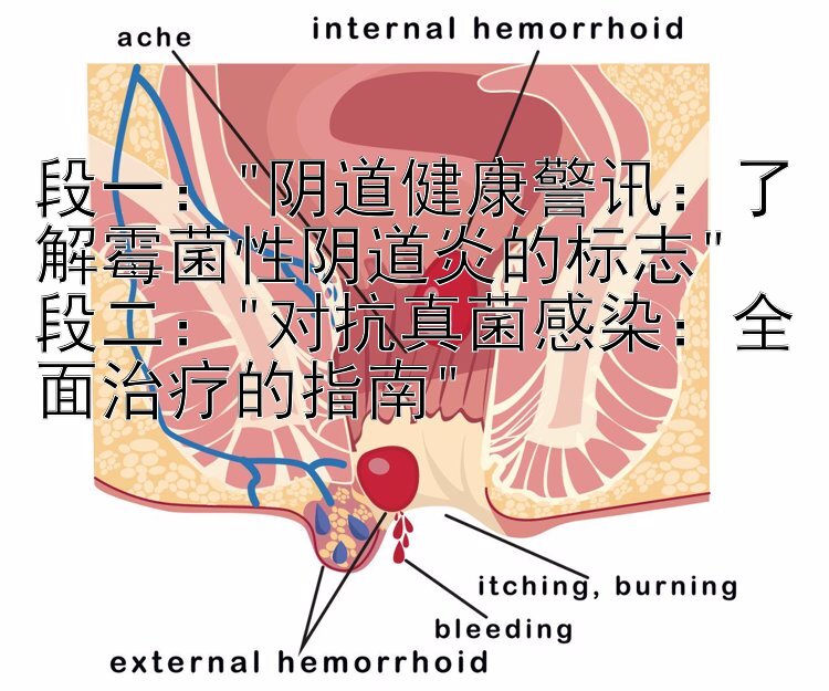 段一：阴道健康警讯：了解霉菌性阴道炎的标志
段二：对抗真菌感染：全面治疗的指南