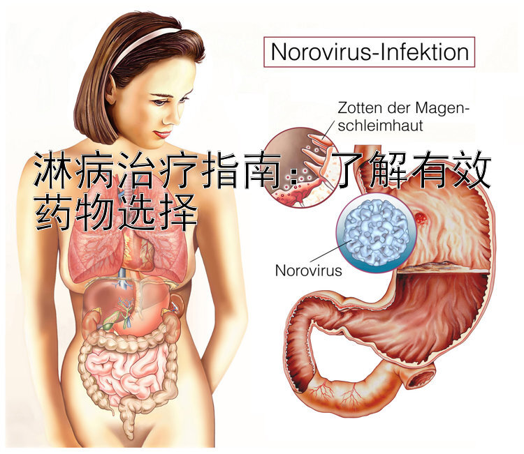 淋病治疗指南：了解有效药物选择