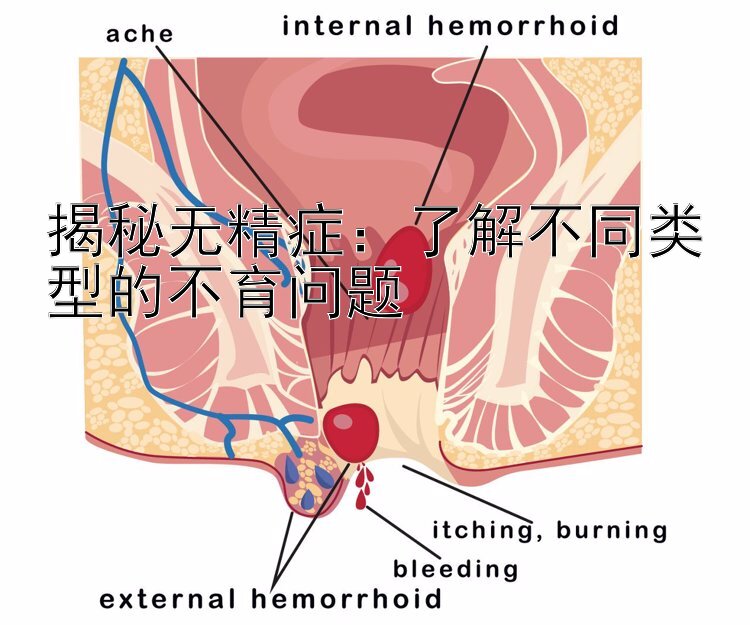 揭秘无精症：了解不同类型的不育问题