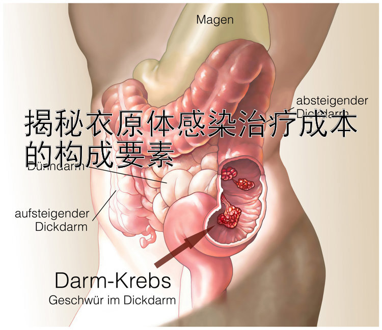 揭秘衣原体感染治疗成本的构成要素