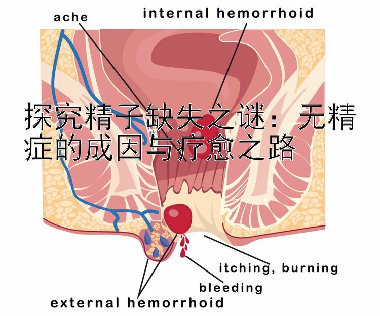 探究精子缺失之谜：无精症的成因与疗愈之路