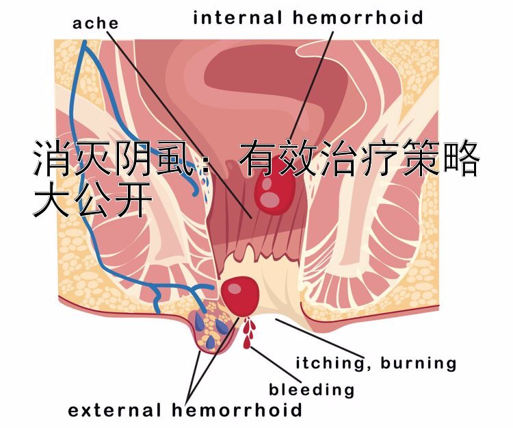 消灭阴虱：有效治疗策略大公开