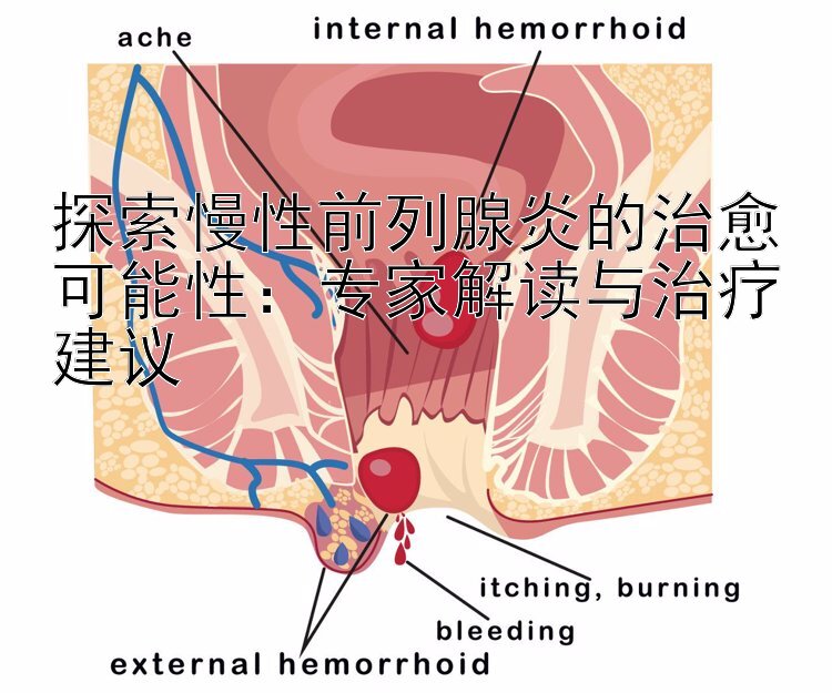 探索慢性前列腺炎的治愈可能性：专家解读与治疗建议