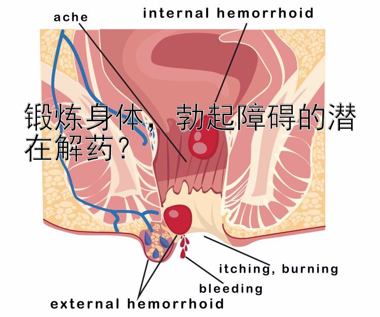 锻炼身体，勃起障碍的潜在解药？