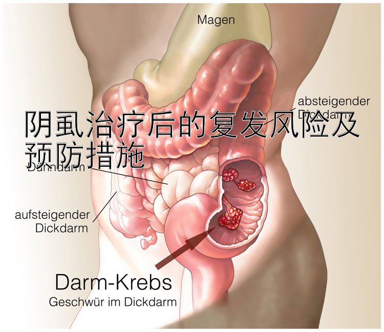 阴虱治疗后的复发风险及预防措施