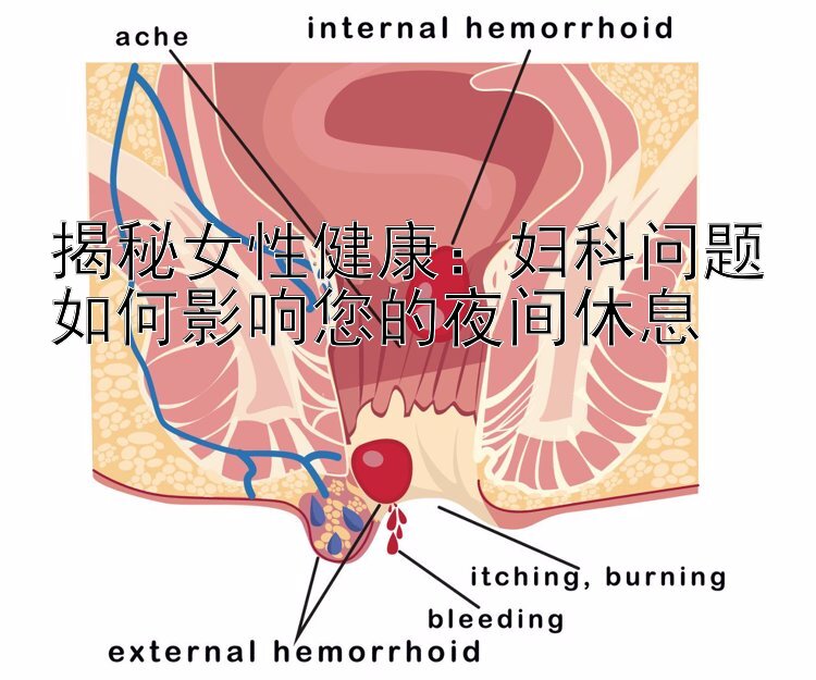 揭秘女性健康：妇科问题如何影响您的夜间休息