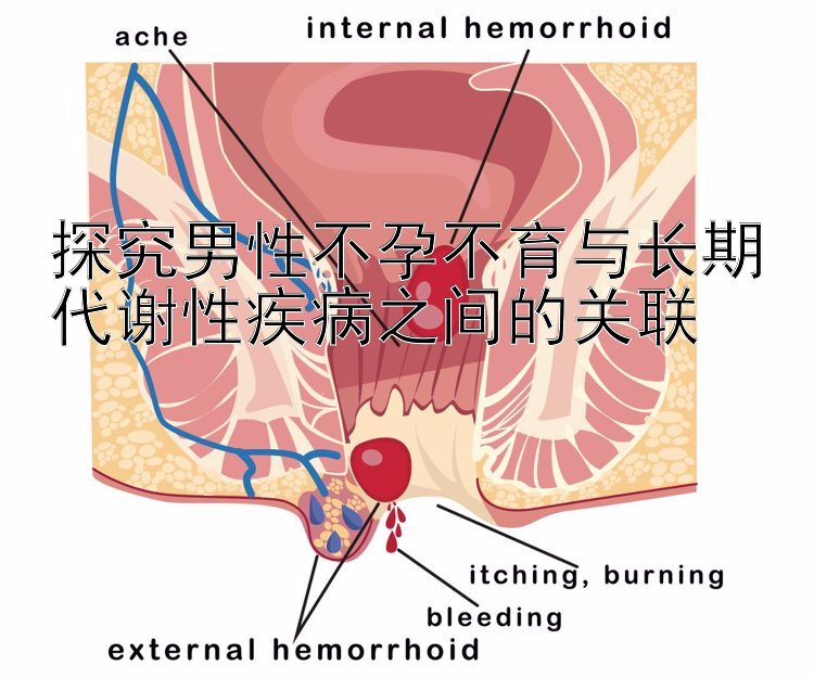 探究男性不孕不育与长期代谢性疾病之间的关联