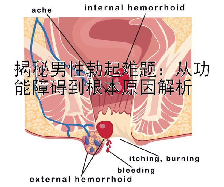 揭秘男性勃起难题：从功能障碍到根本原因解析