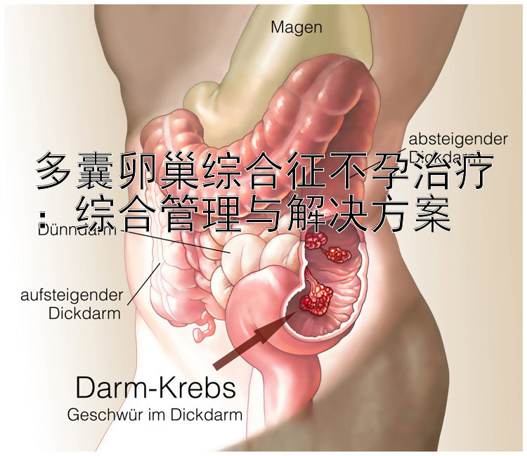 多囊卵巢综合征不孕治疗：综合管理与解决方案