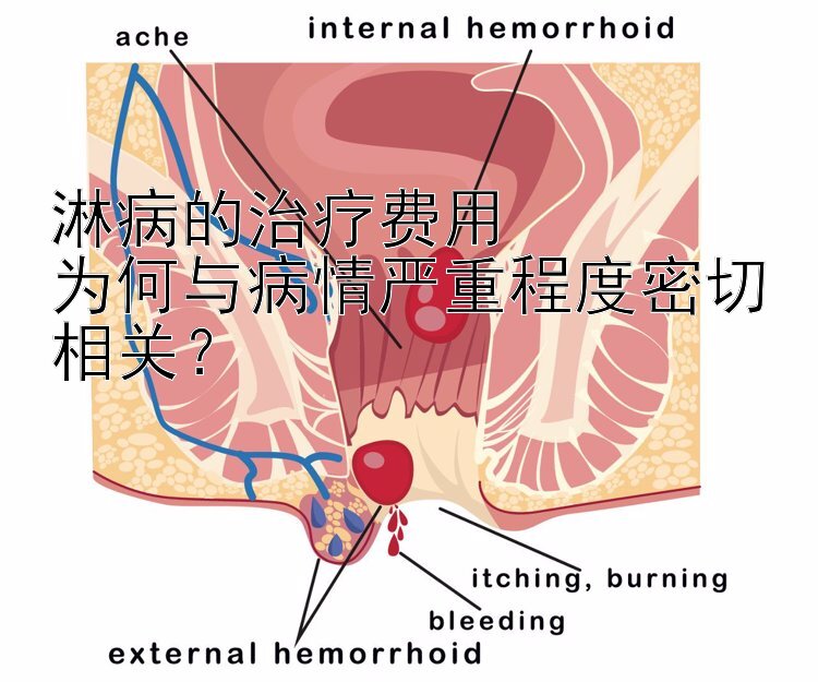 淋病的治疗费用  为何与加拿大28大神官网下载苹果病情严重程度密切相关？